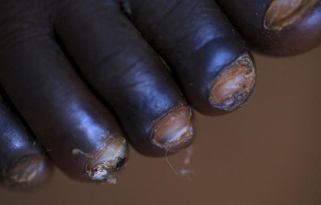 直擊恐怖的非洲沙蚤病,治療全過程曝光