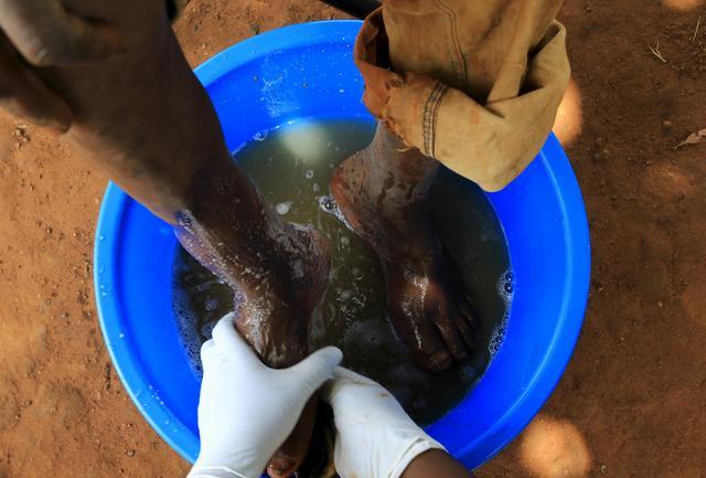 直擊恐怖的非洲沙蚤病,治療全過程曝光