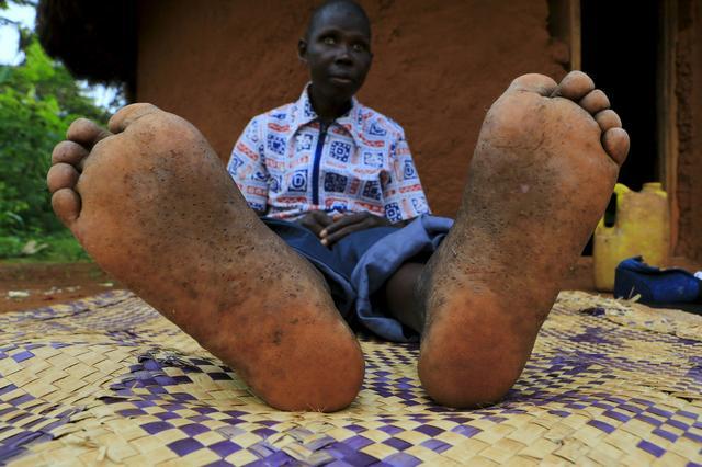 直擊恐怖的非洲沙蚤病,治療全過程曝光