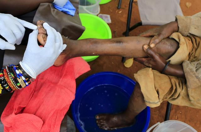 直擊恐怖的非洲沙蚤病,治療全過程曝光