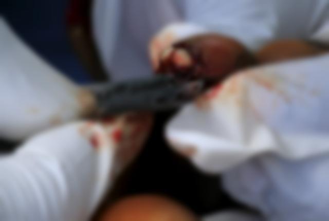 直擊恐怖的非洲沙蚤病,治療全過程曝光