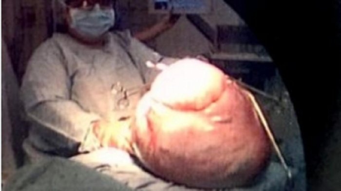 英婦女肚皮脹大近40公分...X光一照醫師大驚：竟藏「7個嬰兒」！網開眼界：不可思議