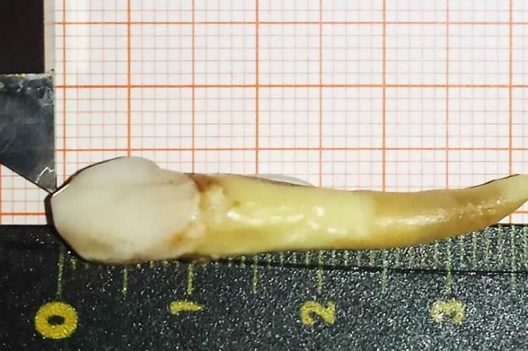 破金氏世界紀錄！男子因牙痛拔牙竟扯出長達XX公分的...網驚：人類史上最長牙4ni