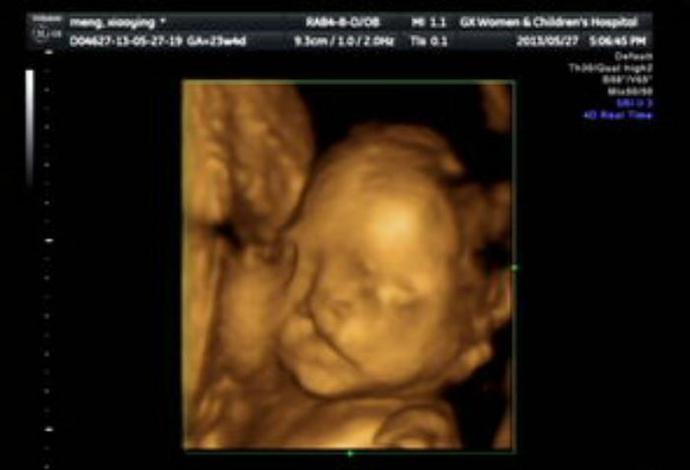 23歲辣妹懷孕6月…超音波一看「胎兒正甜笑、做鬼臉」　醫皺眉：孩子流掉吧！